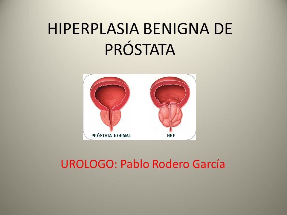Hiperplasia ejemplos